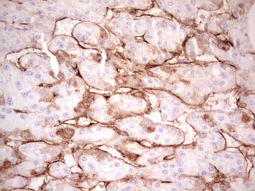 Adiponectin Antibody - Immunohistochemical staining of paraffin-embedded Carcinoma of Human liver tissue using anti-ADIPOQ mouse monoclonal antibody. (Heat-induced epitope retrieval by 1 mM EDTA in 10mM Tris, pH8.5, 120C for 3min,