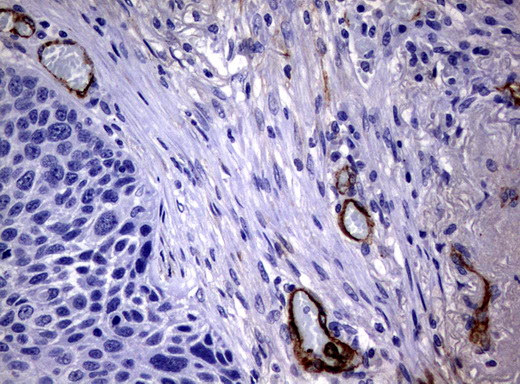 Adiponectin Antibody - Immunohistochemical staining of paraffin-embedded carcinoma of human lung tissue using ADIPOQ clone UMAB104, mouse monoclonal antibody. Heat-induced epitope retrieval by 10mM citric buffer pH6.0 was done at 120C for 3min in pressure chamber/cooker prior toapplication.was diluted 1:100 and detection shown with HRP enzyme and DAB chromogen. Strong cytoplasmic and membranous staining is seen in vessel endothelial cells no staining was seen in tumor cells.