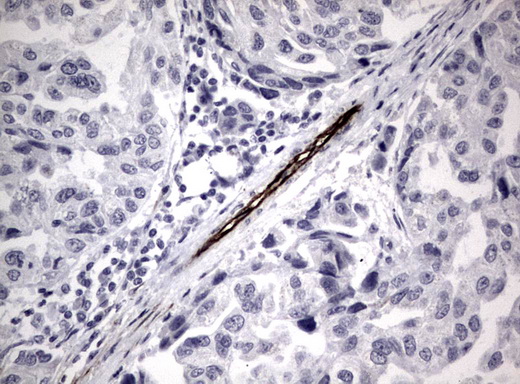 Adiponectin Antibody - Immunohistochemical staining of paraffin-embedded carcinoma of human bladder tissue using ADIPOQ clone UMAB104, mouse monoclonal antibody. Heat-induced epitope retrieval by 10mM citric buffer pH6.0 was done at 120C for 3min in pressure chamber/cooker prior toapplication.was diluted 1:100 and detection shown with HRP enzyme and DAB chromogen. Strong cytoplasmic and membranous staining is seen in vessel endothelial cells no staining was seen in tumor cells.