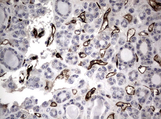 Adiponectin Antibody - Immunohistochemical staining of paraffin-embedded Carcinoma of Human thyroid tissue using anti-ADIPOQ mouse monoclonal antibody.  heat-induced epitope retrieval by 10mM citric buffer, pH6.0, 120C for 3min)