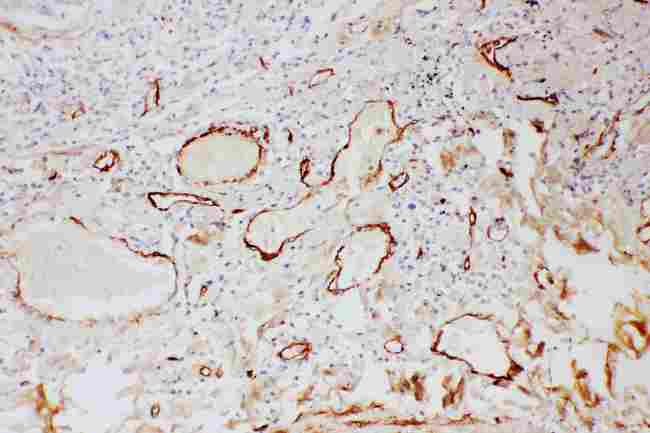 Adiponectin Antibody - anti-Adiponectin antibody IHC(P): Human Lung Cancer Tissue