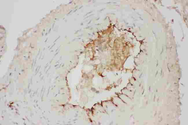 Adiponectin Antibody - anti-Adiponectin antibody IHC(P): Human Mammary Cancer Tissue