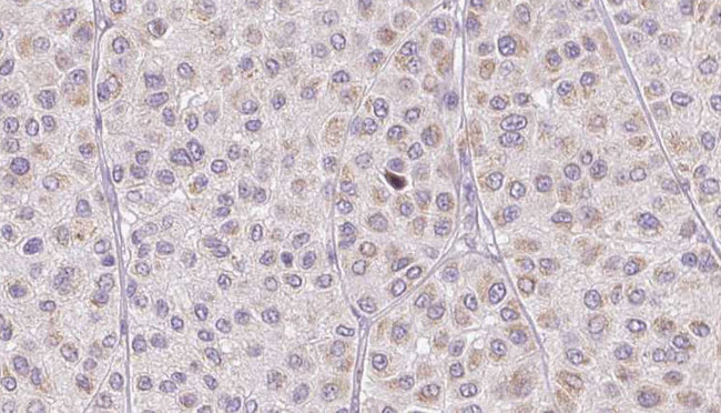 Adiponectin Antibody - 1:100 staining human Melanoma tissue by IHC-P. The sample was formaldehyde fixed and a heat mediated antigen retrieval step in citrate buffer was performed. The sample was then blocked and incubated with the antibody for 1.5 hours at 22°C. An HRP conjugated goat anti-rabbit antibody was used as the secondary.