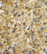 ADIPOR1/Adiponectin Receptor 1 Antibody - Formalin-fixed and paraffin-embedded human hepatocarcinoma with ADIPOR1 Antibody , which was peroxidase-conjugated to the secondary antibody, followed by DAB staining. This data demonstrates the use of this antibody for immunohistochemistry; clinical relevance has not been evaluated.