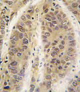 ADK / Adenosine Kinase Antibody - Formalin-fixed and paraffin-embedded human hepatocarcinoma tissue reacted with ADK antibody , which was peroxidase-conjugated to the secondary antibody, followed by DAB staining. This data demonstrates the use of this antibody for immunohistochemistry; clinical relevance has not been evaluated.