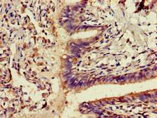 ADK / Adenosine Kinase Antibody - Immunohistochemistry image of paraffin-embedded human lung cancer at a dilution of 1:100