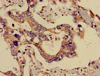 ADK / Adenosine Kinase Antibody - Immunohistochemistry image of paraffin-embedded human pancreatic cancer at a dilution of 1:100