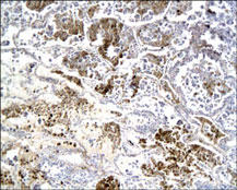 ADM / Adrenomedullin Antibody - Adrenomedullin staining in human lung cancer tissue. Paraffin-embedded human lung cancer tissue is stained with Adrenomedullin antibody used at 1:200 dilution.