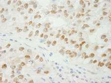 ADNP Antibody - Detection of Human ADNP by Immunohistochemistry. Sample: FFPE section of human breast adenocarcinoma. Antibody: Affinity purified rabbit anti-ADNP used at a dilution of 1:250.