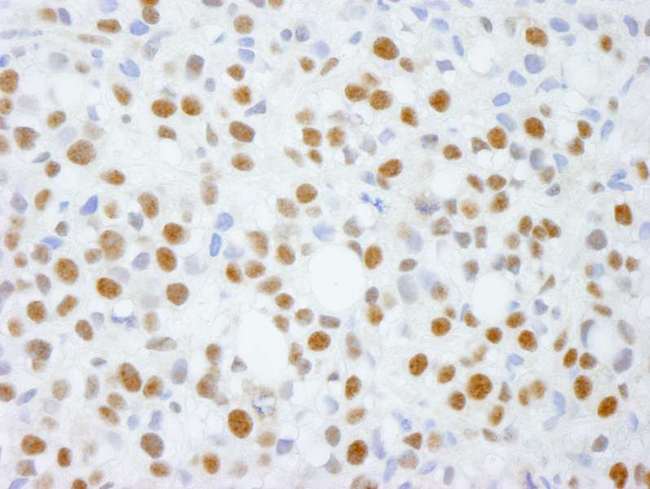 ADNP Antibody - Detection of Human ADNP by Immunohistochemistry. Sample: FFPE section of human metastatic bone marrow. Antibody: Affinity purified rabbit anti-ADNP used at a dilution of 1:250.