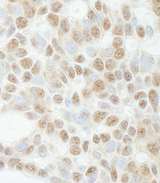 ADNP Antibody - Detection of Human ADNP by Immunohistochemistry. Sample: FFPE section of human skin basal cell carcinoma. Antibody: Affinity purified rabbit anti-ADNP used at a dilution of 1:1000 (1 ug/ml). Detection: DAB.