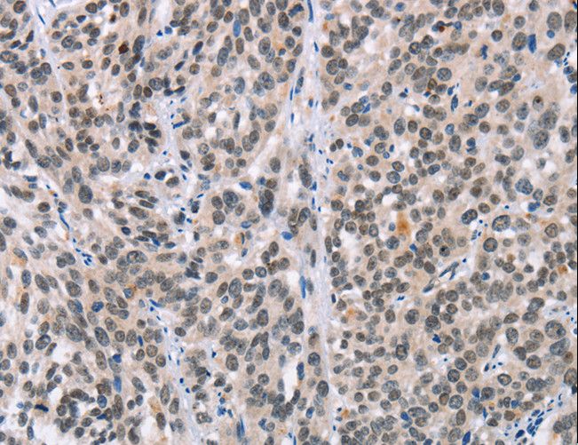ADNP Antibody - Immunohistochemistry of paraffin-embedded Human thyroid cancer using ADNP Polyclonal Antibody at dilution of 1:50.
