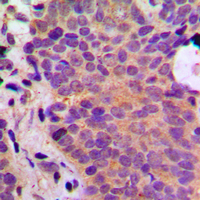 ADPGK Antibody - Immunohistochemical analysis of ADPGK staining in human breast cancer formalin fixed paraffin embedded tissue section. The section was pre-treated using heat mediated antigen retrieval with sodium citrate buffer (pH 6.0). The section was then incubated with the antibody at room temperature and detected using an HRP conjugated compact polymer system. DAB was used as the chromogen. The section was then counterstained with hematoxylin and mounted with DPX.