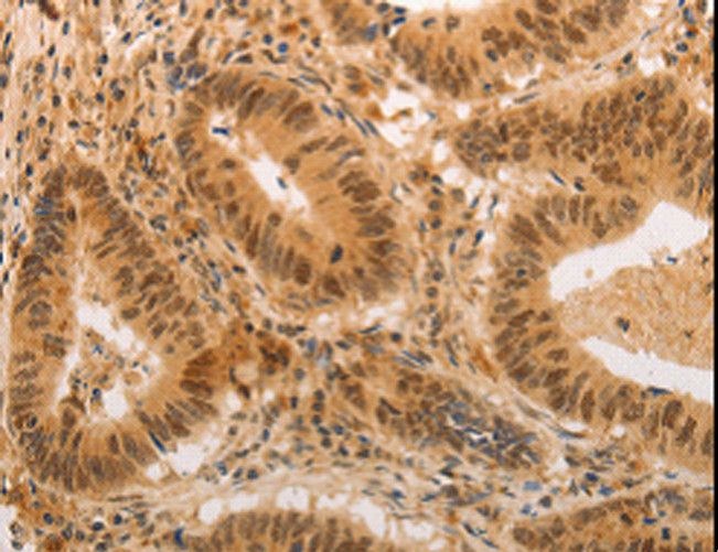 ADRA1B / Adrenoceptor alpha 1B Antibody - Immunohistochemistry of paraffin-embedded Human colon cancer using ADRA1B Polyclonal Antibody at dilution of 1:20.