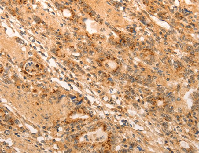 ADRA1B / Adrenoceptor alpha 1B Antibody - Immunohistochemistry of paraffin-embedded Human gastric cancer using ADRA1B Polyclonal Antibody at dilution of 1:20.