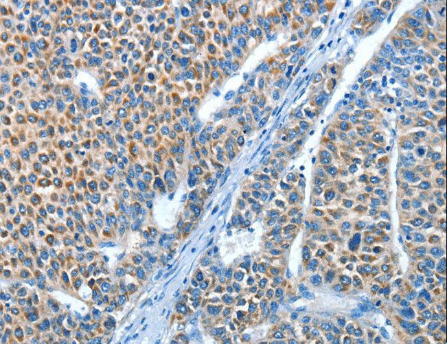 ADRA1B / Adrenoceptor alpha 1B Antibody - Immunohistochemistry of paraffin-embedded Human liver cancer using ADRA1B Polyclonal Antibody at dilution of 1:25.