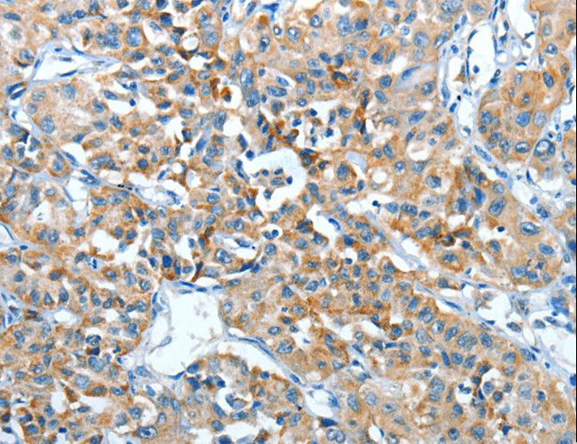 ADRA1B Antibody - Immunohistochemistry of paraffin-embedded Human lung cancer using ADRA1B Polyclonal Antibody at dilution of 1:25.