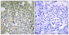 ADRA1D / Adrenoceptor alpha 1D Antibody - Immunohistochemistry analysis of paraffin-embedded human breast carcinoma tissue, using ADRA1D Antibody. The picture on the right is blocked with the synthesized peptide.