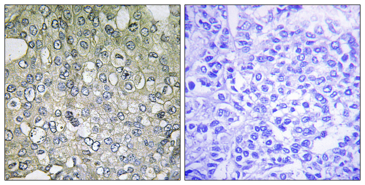 ADRA1D Antibody - Immunohistochemistry analysis of paraffin-embedded human breast carcinoma tissue, using ADRA1D Antibody. The picture on the right is blocked with the synthesized peptide.