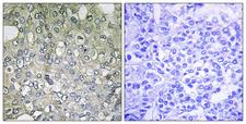 ADRA1D Antibody - Peptide - + Immunohistochemistry analysis of paraffin-embedded human breast carcinoma tissue using ADRA1D antibody.