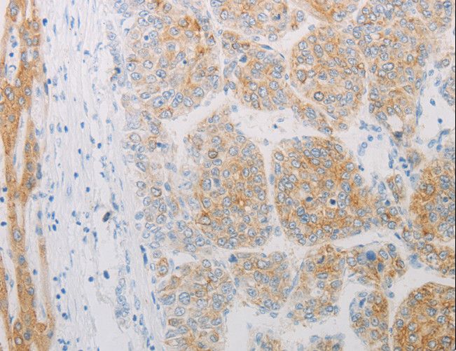 ADRB2 Antibody - Immunohistochemistry of paraffin-embedded Human liver cancer using ADRB2 Polyclonal Antibody at dilution of 1:20.