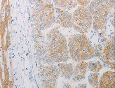 ADRB2 Antibody - Immunohistochemistry of paraffin-embedded Human liver cancer using ADRB2 Polyclonal Antibody at dilution of 1:20.
