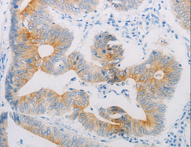 ADRB2 Antibody - Immunohistochemistry of paraffin-embedded Human colon cancer using ADRB2 Polyclonal Antibody at dilution of 1:20.