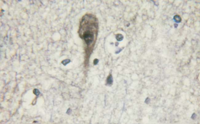 ADRB2 Antibody - 1/100 staining human brain tissue by IHC-P. The sample was formaldehyde fixed and a heat mediated antigen retrieval step in citrate buffer was performed. The sample was then blocked and incubated with the antibody for 1.5 hours at 22°C. An HRP conjugated goat anti-rabbit antibody was used as the secondary antibody.