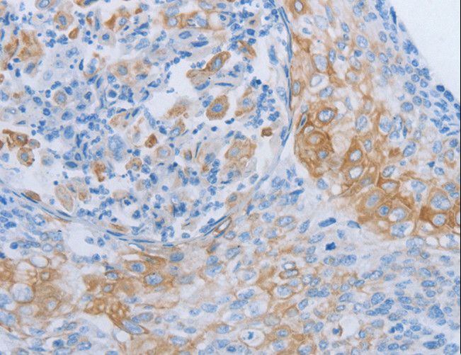 ADRB3 Antibody - Immunohistochemistry of paraffin-embedded Human cervical cancer using ADRB3 Polyclonal Antibody at dilution of 1:60.