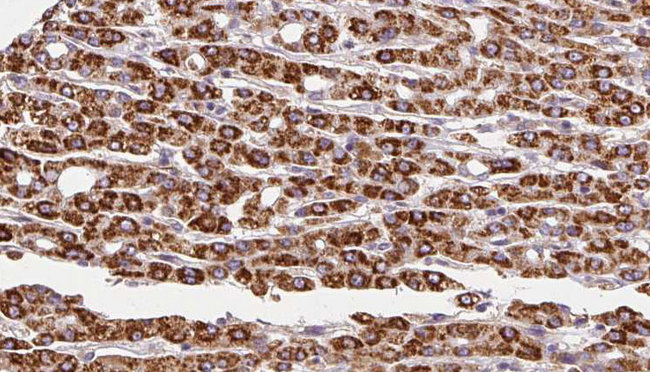 ADRB3 Antibody - 1:100 staining human liver carcinoma tissues by IHC-P. The sample was formaldehyde fixed and a heat mediated antigen retrieval step in citrate buffer was performed. The sample was then blocked and incubated with the antibody for 1.5 hours at 22°C. An HRP conjugated goat anti-rabbit antibody was used as the secondary.