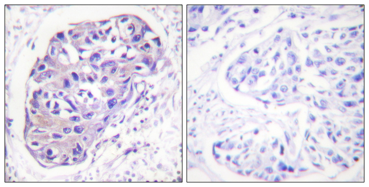 ADRBK1 / GRK2 Antibody - Immunohistochemistry analysis of paraffin-embedded human breast carcinoma tissue, using GRK2 Antibody. The picture on the right is blocked with the synthesized peptide.
