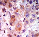 ADRBK1 / GRK2 Antibody - Formalin-fixed and paraffin-embedded human cancer tissue reacted with the primary antibody, which was peroxidase-conjugated to the secondary antibody, followed by AEC staining. This data demonstrates the use of this antibody for immunohistochemistry; clinical relevance has not been evaluated. BC = breast carcinoma; HC = hepatocarcinoma.