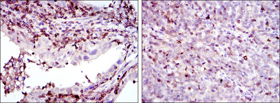 ADRBK1 / GRK2 Antibody - IHC of paraffin-embedded endometrial cancer tissues (left) and cervical cancer tissues (right) using GRK2 mouse monoclonal antibody with DAB staining.