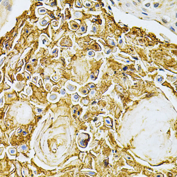 ADRBK1 / GRK2 Antibody - Immunohistochemistry of paraffin-embedded human esophageal cancer using ADRBK1 Antibodyat dilution of 1:200 (40x lens).