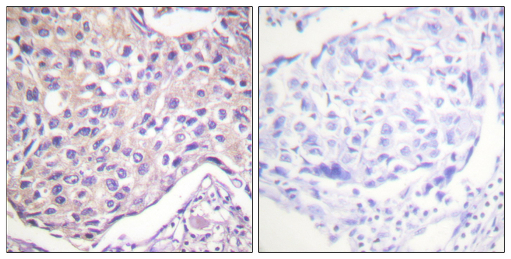 ADRBK1 / GRK2 Antibody - Immunohistochemistry analysis of paraffin-embedded human breast carcinoma, using GRK2 (Phospho-Ser29) Antibody. The picture on the right is blocked with the phospho peptide.