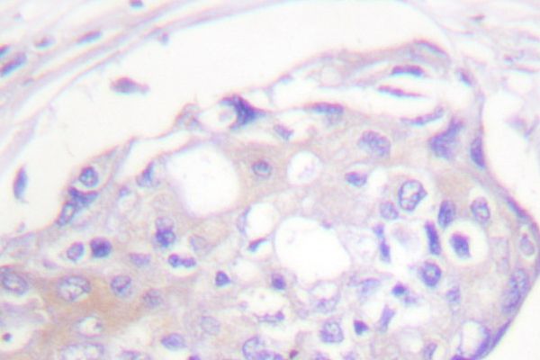ADRBK1 / GRK2 Antibody - IHC of GRK2 (T23) pAb in paraffin-embedded human breast carcinoma tissue.