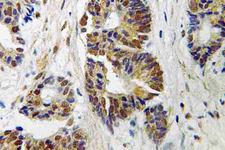 ADRBK1 / GRK2 Antibody - IHC of GRK 2 (V678) pAb in paraffin-embedded human colon carcinoma tissue.