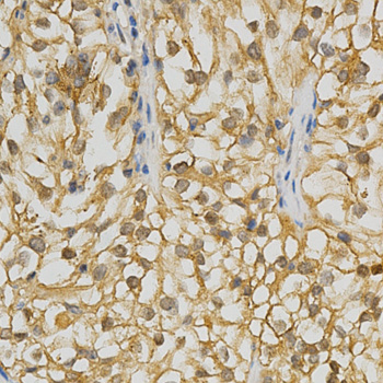 ADRBK2 / GRK3 Antibody - Immunohistochemistry of paraffin-embedded human kidney cancer tissue.