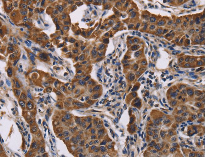 ADRBK2 / GRK3 Antibody - Immunohistochemistry of paraffin-embedded Human lung cancer using ADRBK2 Polyclonal Antibody at dilution of 1:50.