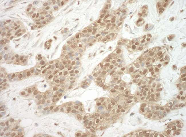 ADRM1 Antibody - Detection of Human ADRM1 by Immunohistochemistry. Sample: FFPE section of human breast carcinoma. Antibody: Affinity purified rabbit anti-ADRM1 used at a dilution of 1:1000 (1 ug/ml).