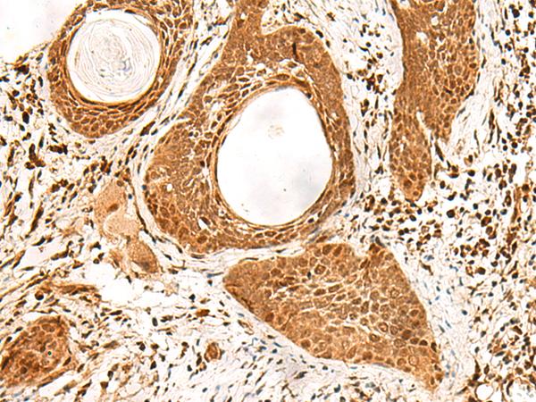 ADRM1 Antibody - Immunohistochemistry of paraffin-embedded Human esophagus cancer tissue  using ADRM1 Polyclonal Antibody at dilution of 1:70(×200)