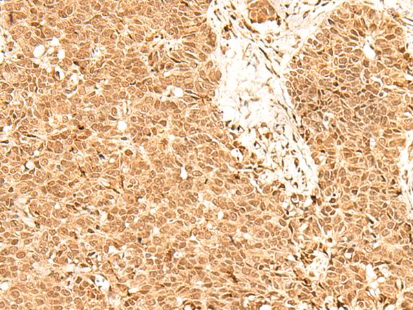 ADRM1 Antibody - Immunohistochemistry of paraffin-embedded Human ovarian cancer tissue  using ADRM1 Polyclonal Antibody at dilution of 1:70(×200)