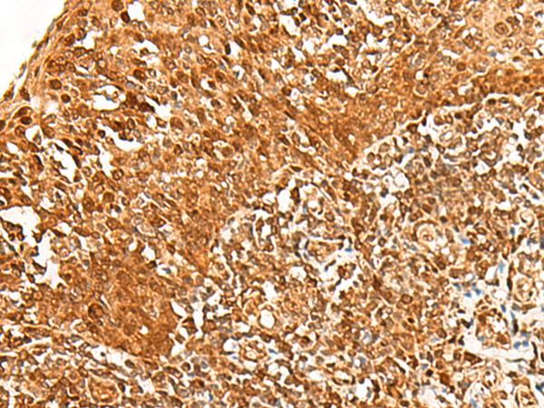 ADRM1 Antibody - Immunohistochemistry of paraffin-embedded Human tonsil tissue  using ADRM1 Polyclonal Antibody at dilution of 1:30(×200)