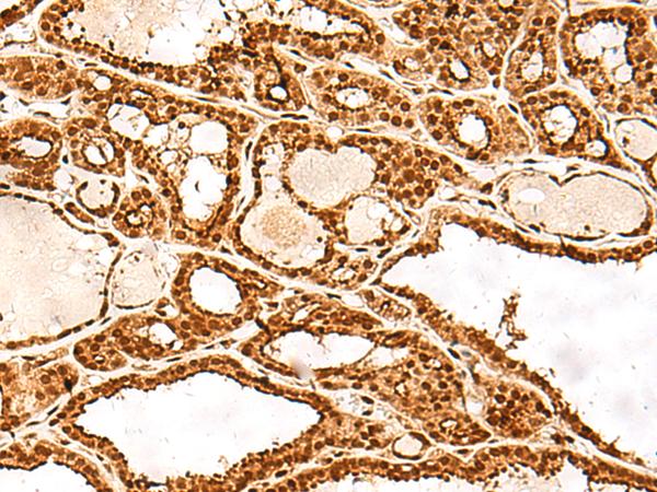 ADRM1 Antibody - Immunohistochemistry of paraffin-embedded Human thyroid cancer tissue  using ADRM1 Polyclonal Antibody at dilution of 1:30(×200)