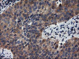 ADSL / Adenylosuccinate Lyase Antibody - Immunohistochemical staining of paraffin-embedded Carcinoma of Human bladder tissue using anti-ADSL mouse monoclonal antibody.