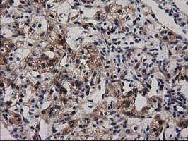 ADSL / Adenylosuccinate Lyase Antibody - Immunohistochemical staining of paraffin-embedded Carcinoma of Human kidney tissue using anti-ADSL mouse monoclonal antibody.