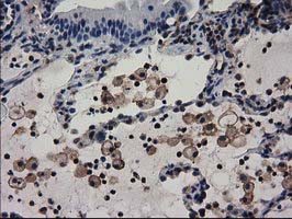 ADSL / Adenylosuccinate Lyase Antibody - Immunohistochemical staining of paraffin-embedded Carcinoma of Human lung tissue using anti-ADSL mouse monoclonal antibody.