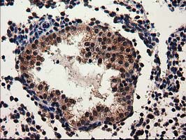 ADSL / Adenylosuccinate Lyase Antibody - Immunohistochemical staining of paraffin-embedded Carcinoma of Human prostate tissue using anti-ADSL mouse monoclonal antibody.