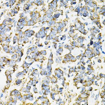 ADSS Antibody - Immunohistochemistry of paraffin-embedded human lung cancer using ADSS antibody at dilution of 1:100 (40x lens).