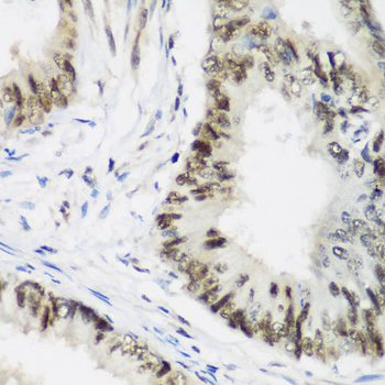 AEBP2 Antibody - Immunohistochemistry of paraffin-embedded human colon carcinoma tissue.